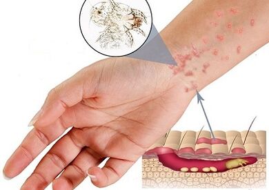 manifestation of the presence of subcutaneous parasites in humans