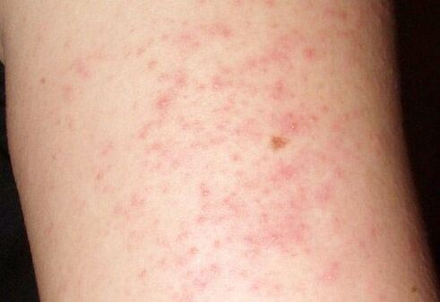 An itchy skin rash is a symptom of the presence of worms in the liver