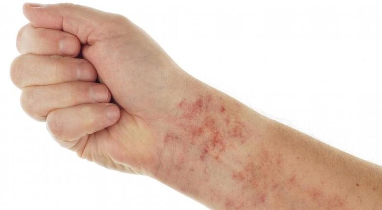 rash on the skin if there are parasites in the body